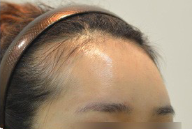 매몰법 전 AFTER 1