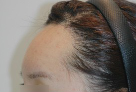 매몰법 전 AFTER 1