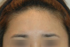 매몰법 전 BEFORE 1