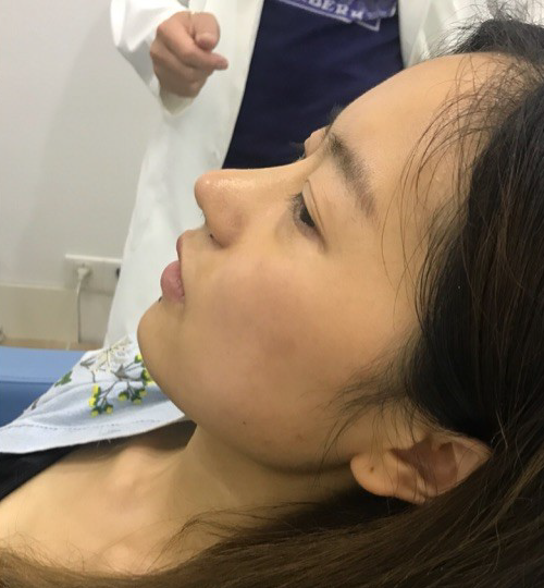 매몰법 전 AFTER 1