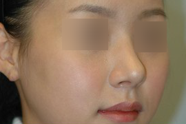 매몰법 전 AFTER 1