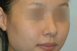 매몰법 전 BEFORE 1