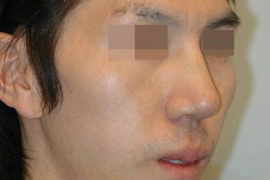 매몰법 전 AFTER 1