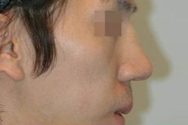 매몰법 전 AFTER 1