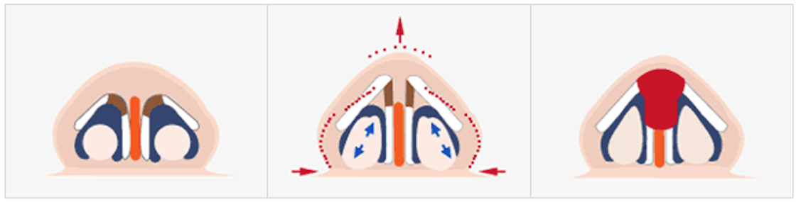 코 끝 성형술 방법