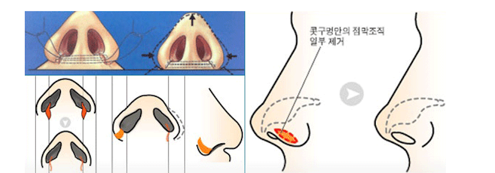 코 끝 성형술 방법
