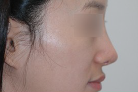 매몰법 전 AFTER 1