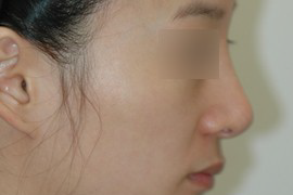 매몰법 전 BEFORE 1